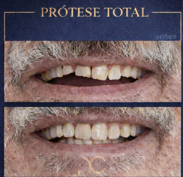 Prótese Total